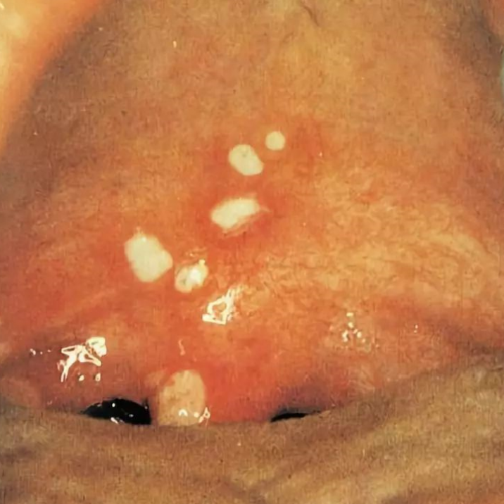疱疹性咽峡炎嗓子图片图片